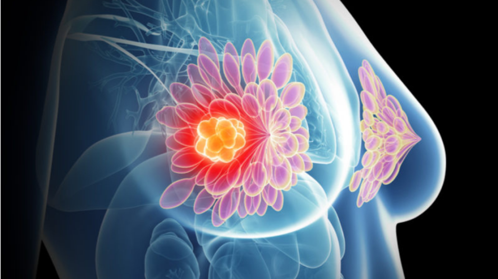 breast cancer