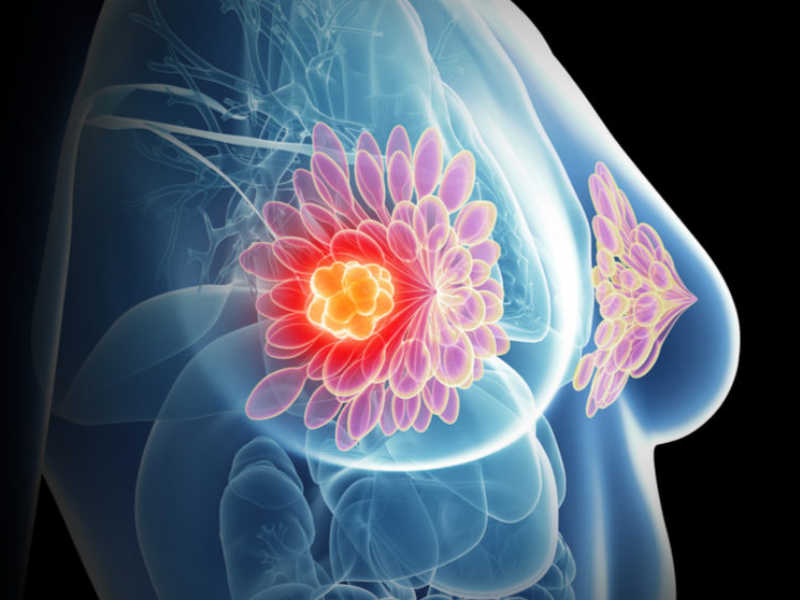 Scientist Advises Caution When Using AI in Mammography