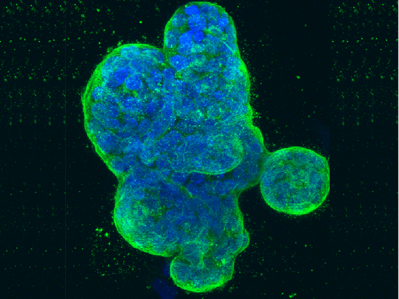 Scientists Discover Breast Cancer Protein that Could Anticipate Chemotherapy Sensitivity