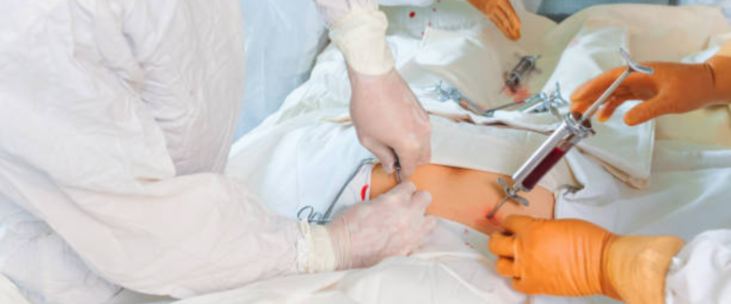 Traditional application of treatment. 