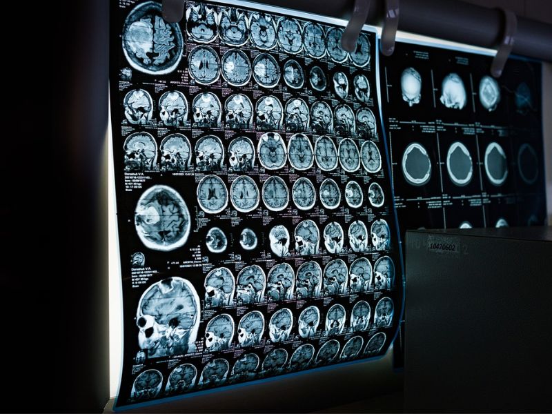 A Man Destined for Alzheimer’s Defied It for Decades—Here’s How