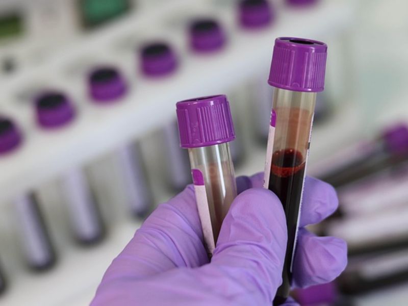 The US Has Recently Approved The First Blood Test For Alzheimer’s Disease