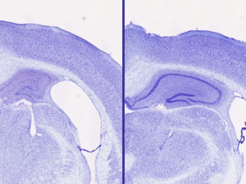 Alzheimer’s Breakthrough: Sleep Medication Reduces Harmful Tau Buildup by Up to 40%