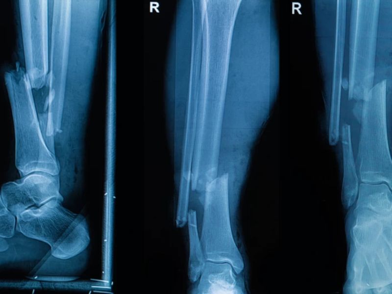 A Glue Gun Applies Bone Graft Material Straight Onto Fractures in The Middle of Surgery