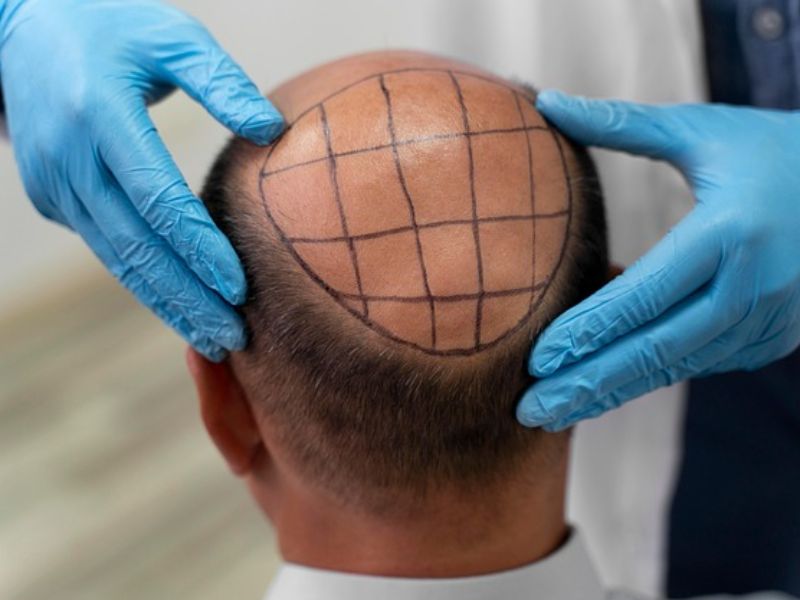 Have Experts Solved Baldness, and How are Geneticists Stimulating New Hair Growth?