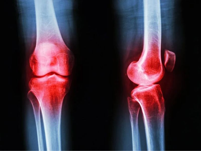 The Osteoarthritis Treatment Thought To Be The “Most Effective” May Not Be As Helpful As Once Believed