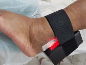 Brazilian woman creates device that speeds diabetic wound healing, preventing amputations