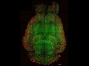 Blood nanofilter removes Alzheimer’s proteins in hours, potentially reversing dementia